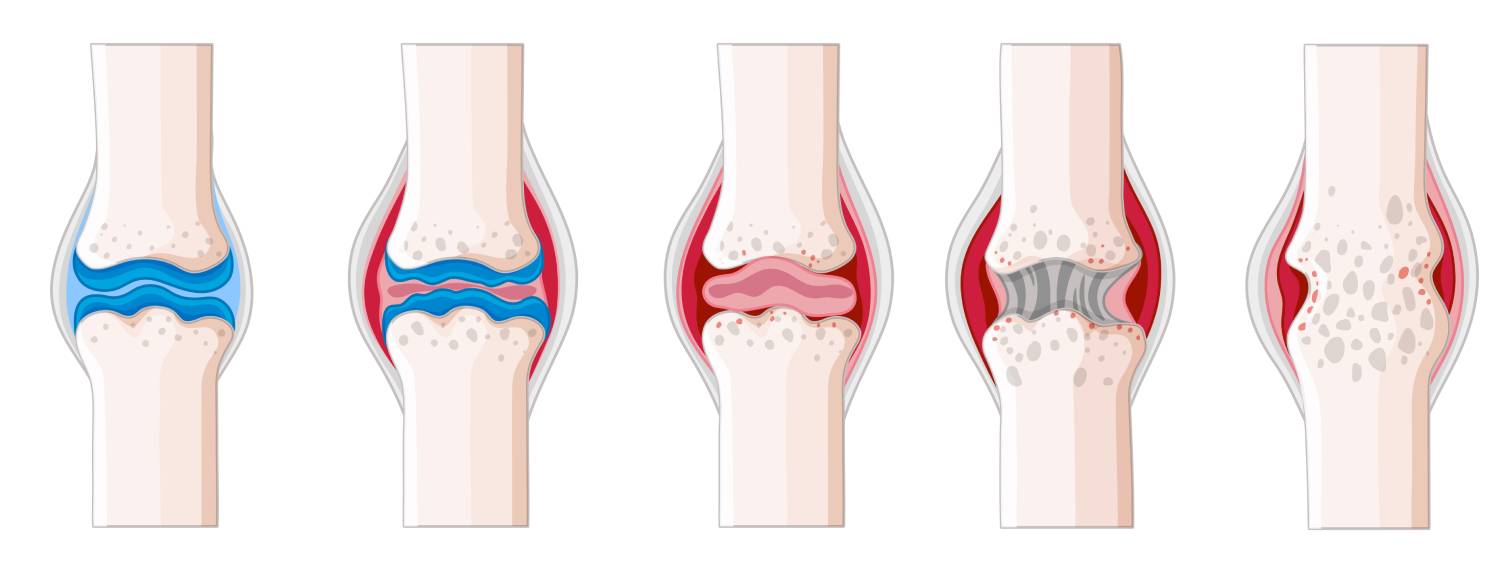 Artritis reumatoide en el cuerpo humano